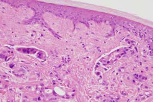 Invasion of dermal lymphatics and dermal connective tissue by recurrent carcinoma of breast